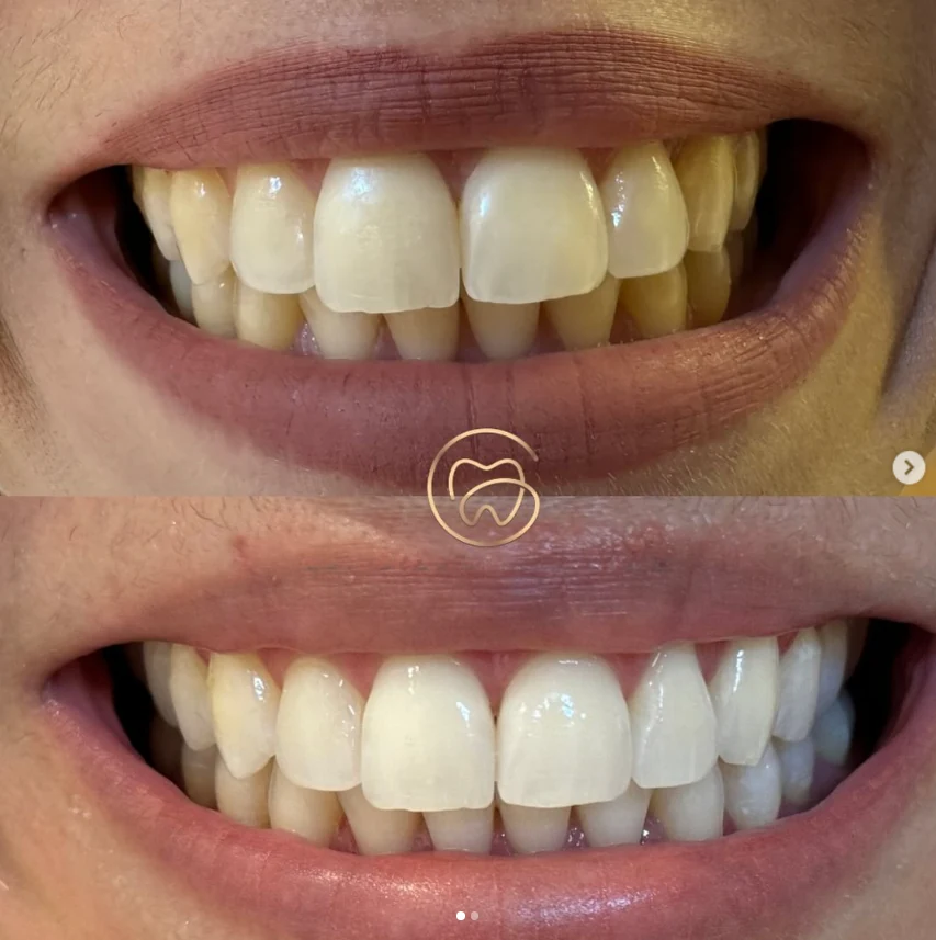 Antes e depois de tratamento odontológico realizado no consultório