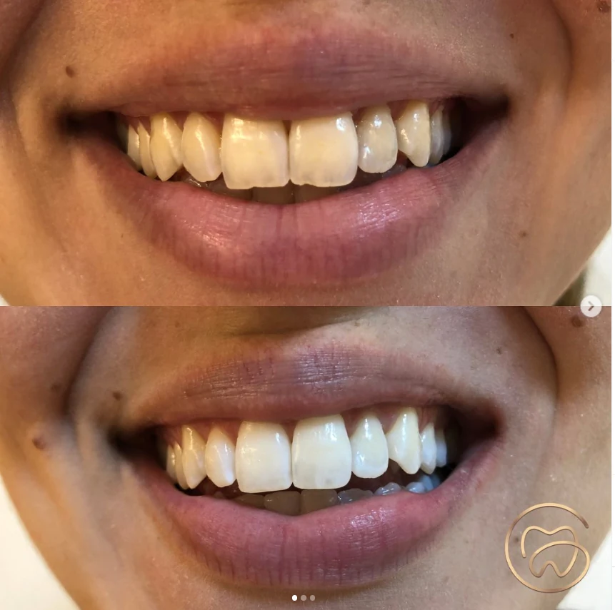 Antes e depois de tratamento odontológico com melhora do sorriso